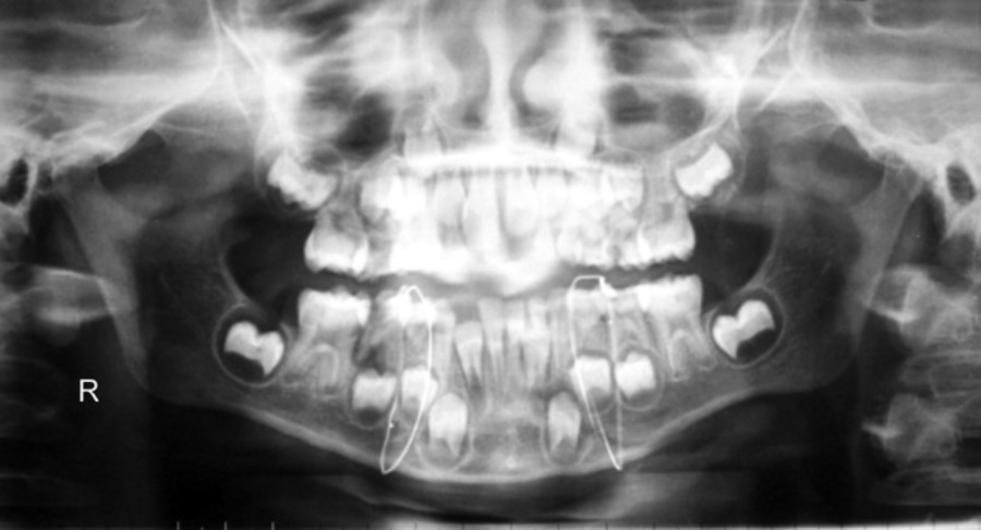 Можно ли с зубным имплантом делать мрт. Мрт с металлическими коронками. Металлические имплантаты мрт.