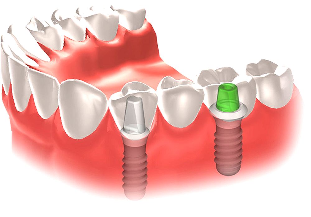 Восстановление после имплантов. Заживления десен после имплантации зубов. Имплантация зубов заживление.