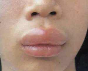 Опухоль губ причины