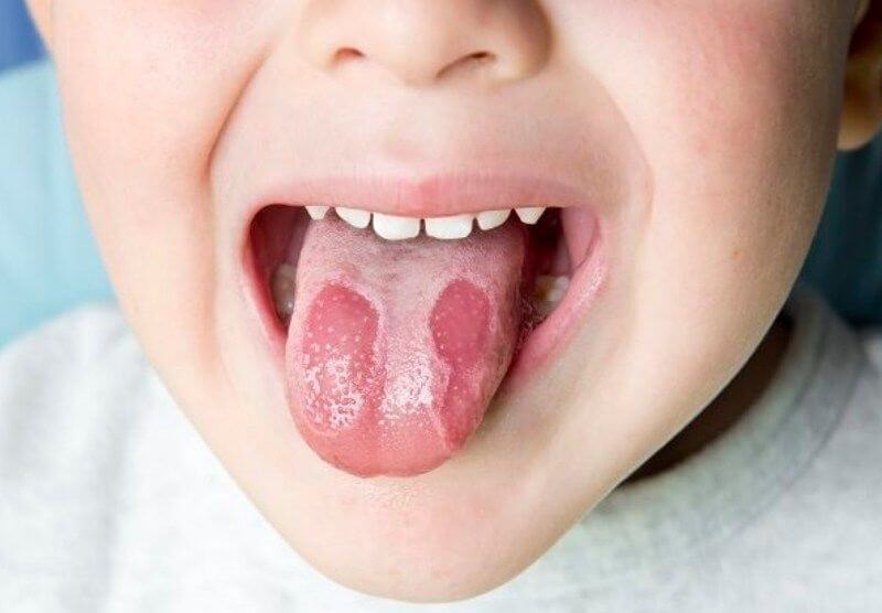 Травматическая язва языка как лечить