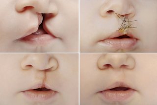 Pictures of cleft lip before and after surgery