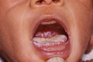 White coating on child