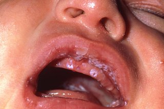 White spots inside a baby