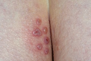 Herpes blisters and open sores (ulcers) on the buttocks