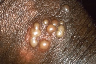 Herpes blisters on the skin of a penis