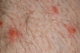 Mosquito bites