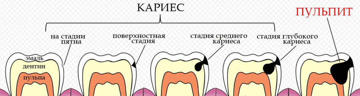 Стадии кариеса картинки