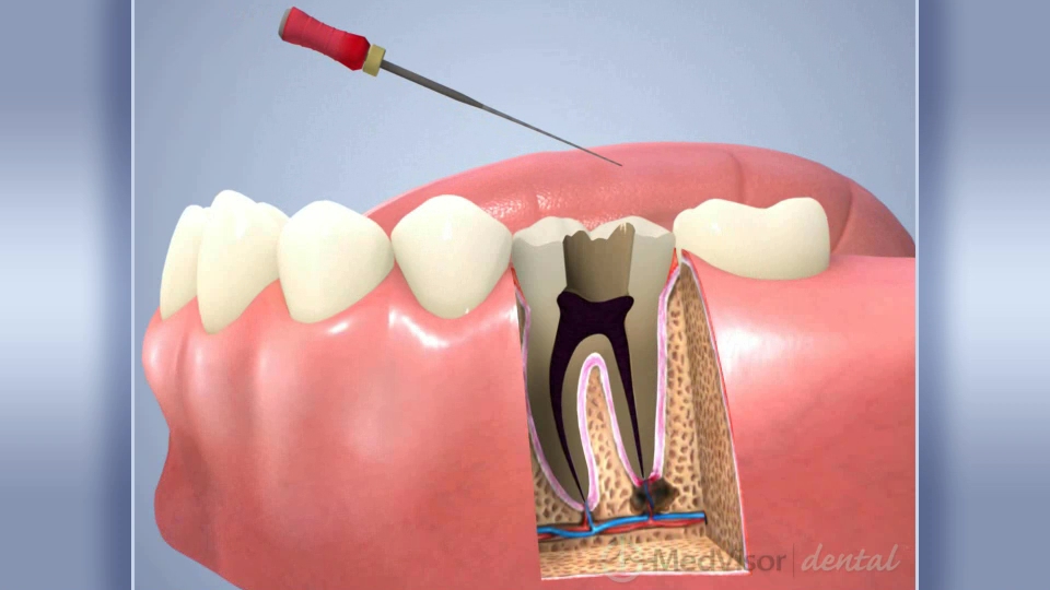 Нерв в зубе что делать
