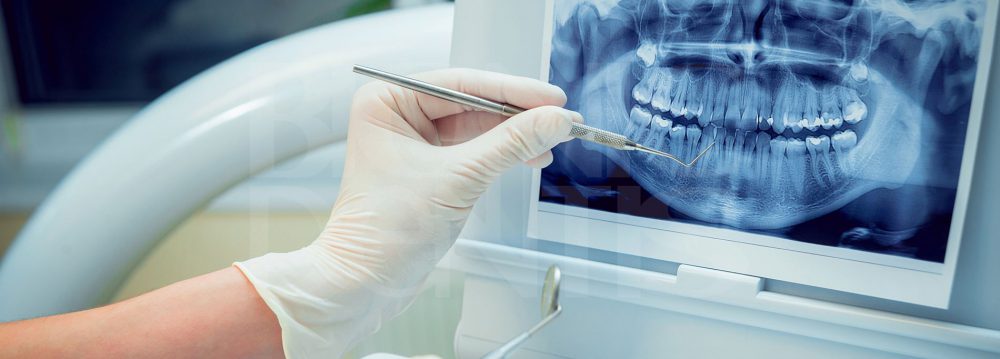 лечение перфорации корня зуба