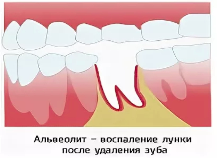 Чем полоскать рот при удалении зуба