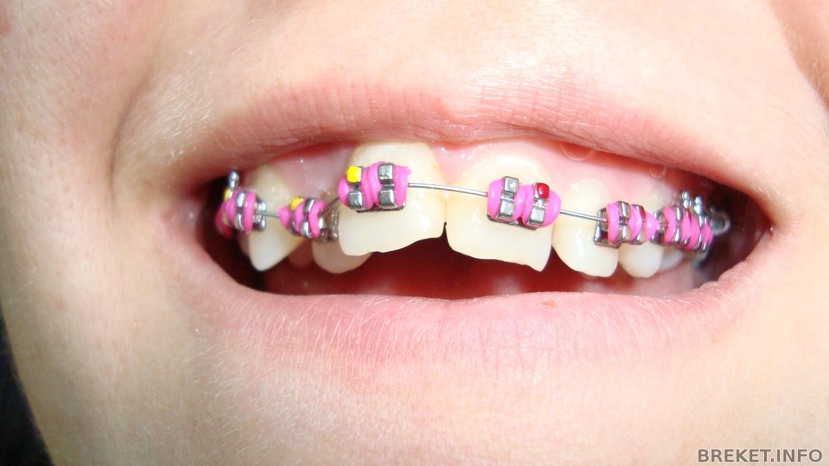 Брекеты на зубы для детей сколько стоят. Брекеты с маленькими замками. Детская брекет система на 4 зуба.