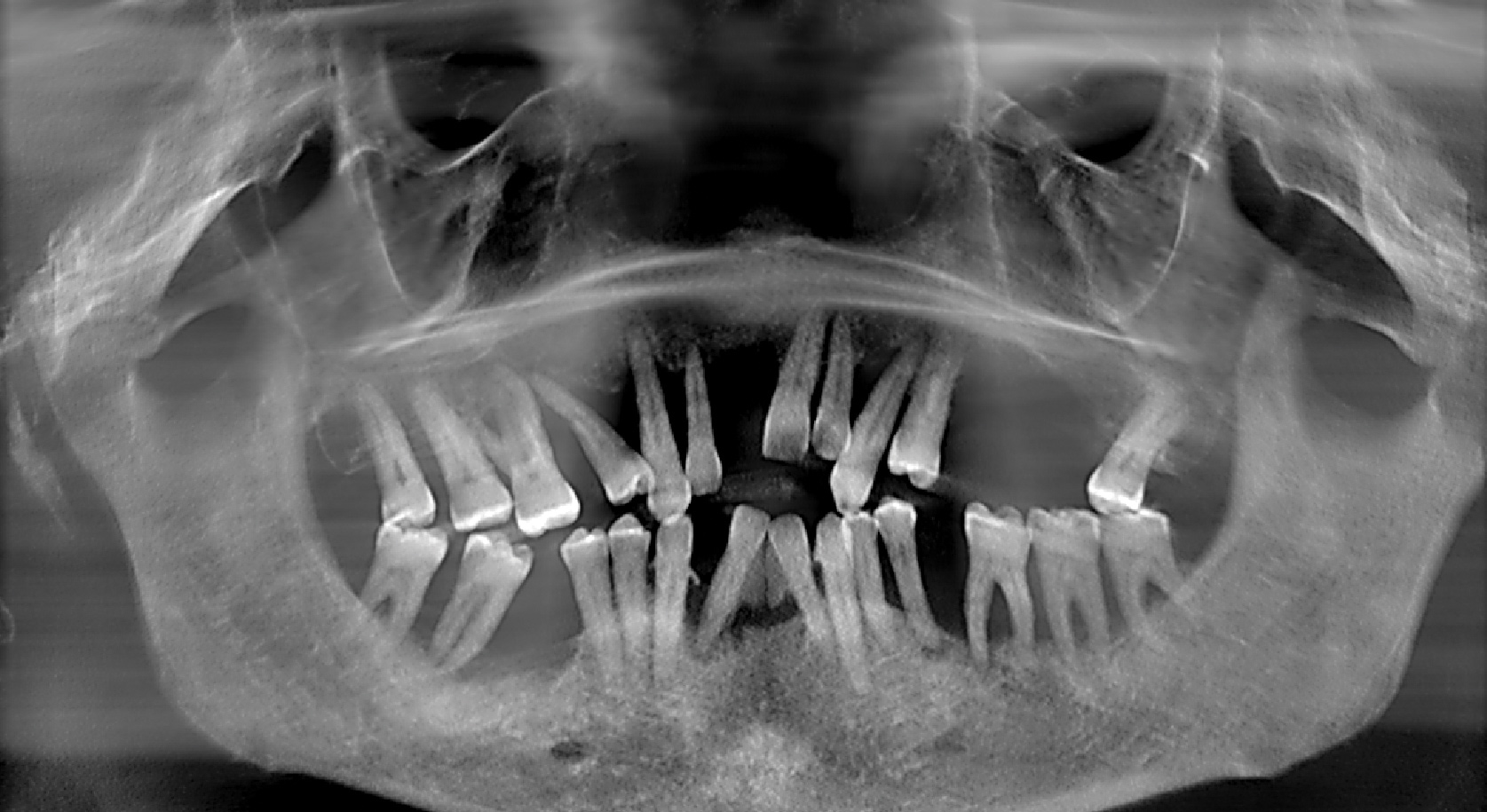 Снимок. Ортопантомограмма пародонтит. Рентген ортопантомограмма зубов. Пародонтит снимок ОПТГ. Ортопантомограмма пародонтит тяжелой степени.