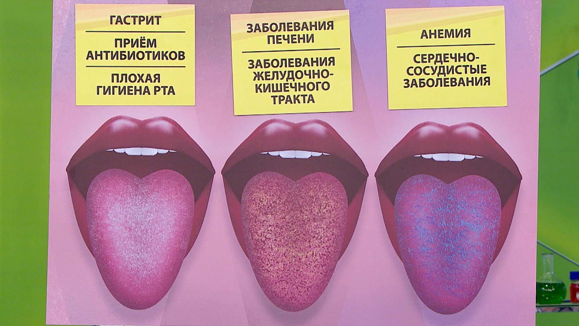 Язык человека определить болезнь. Заболевания по цвету языка.