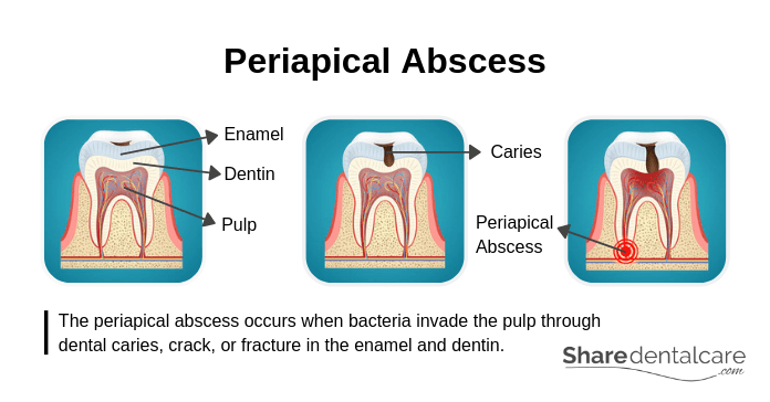 Periapical Abscess