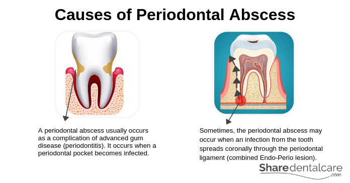 Causes of Periodontal Abscess