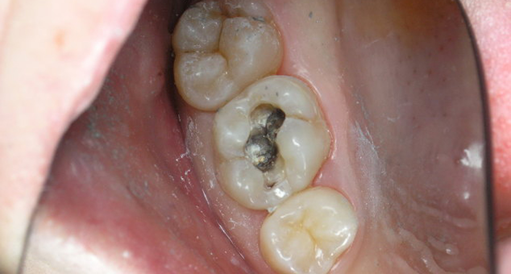 На фото показан пульпит зуба