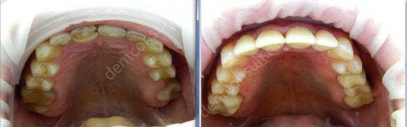 Фото: До и после восстановления стертых зубов