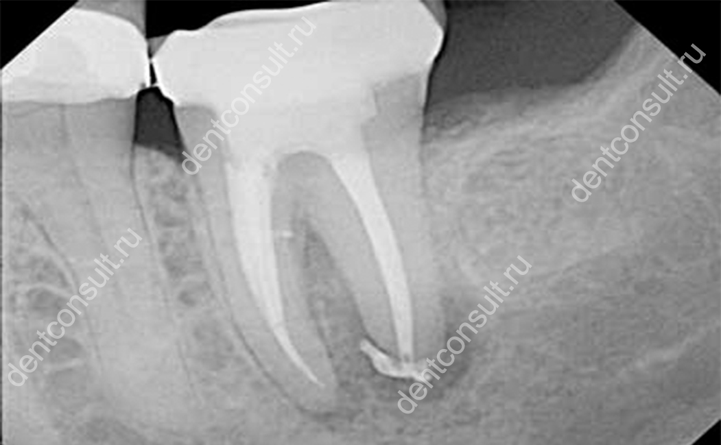 Перфорация корня зуба. Перфорации стенки корневого канала зуба. Апикальная перфорация стенки корневого канала. Перфорация корневого канала штифтом. Продольная перфорация стенки корневого канала.