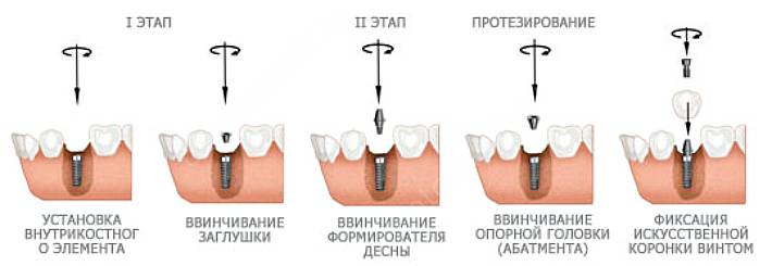Классический двухэтапный метод имплантация зубов