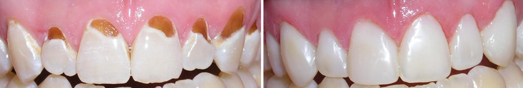 Некроз зубов до и после лечения
