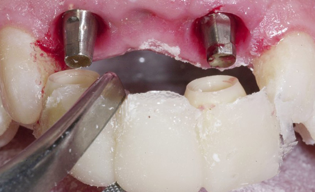 Установка временного зубного протеза на импланты