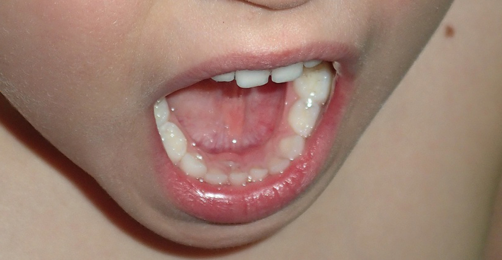 Если молочные зубы не выпадают вовремя, то может сформироваться неправильный прикус постоянных зубов