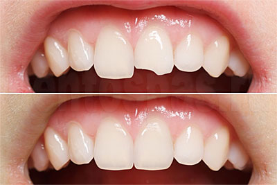Скол на зубах - до и после реставрации