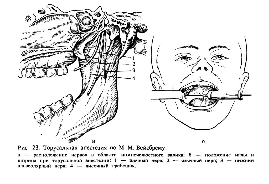 Проводниковая анестезия анестетики. Торусальная анестезия нижней челюсти. Проводниковая анестезия нижней челюсти. Проводниковая анестезия нижней челюсти мандибулярная. Проводниковая анестезия на верхней челюсти и на нижней челюсти.