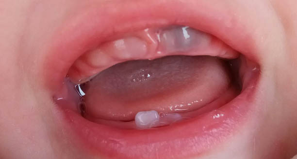 десна перед прорезыванием зуба