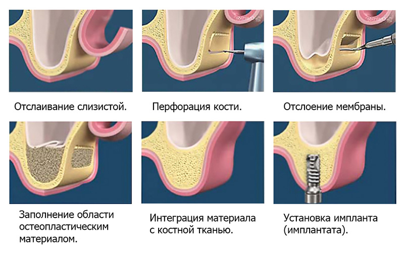 Синус-лифтинг