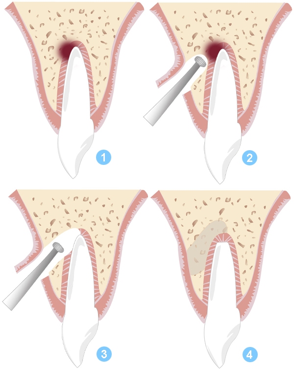резекция апекса корня зуба