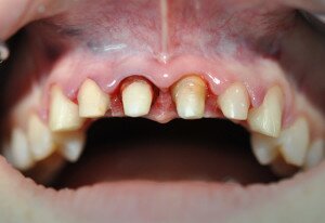 Обточка зубов перед протезированием