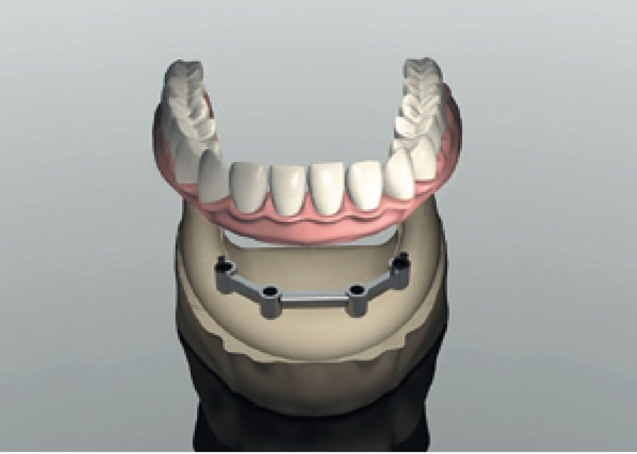 Условно съемный протез на балке. Бюгельный протез балочная система. Балочный протез на имплантах. Балка на имплантатах аттачмент mk1. Балочный протез на 4 имплантах.