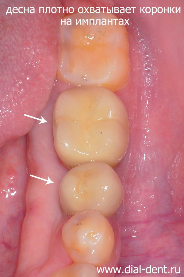 постоянные коронки установлены на зубные импланты