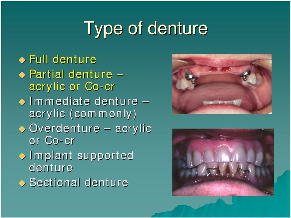 acrylic (commonly) Overdenture acrylic or