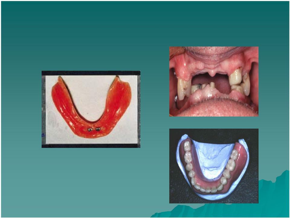 acrylic (commonly) Overdenture acrylic or