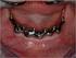 Retention of maxillary implant overdenture bars of different designs