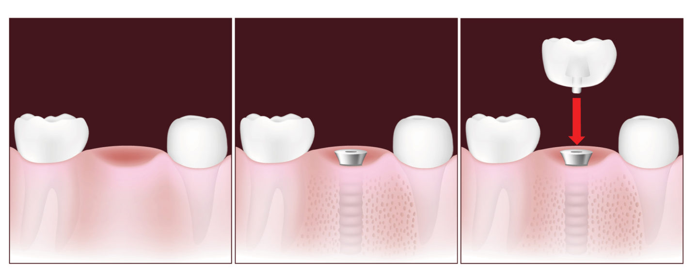 Зубы импланты поэтапно. Двухэтапная методика имплантации зубов. Имплант Adin одноэтапная. Мостовидные протезы на имплантах. Двухэтапная имплантация зубов этапы.