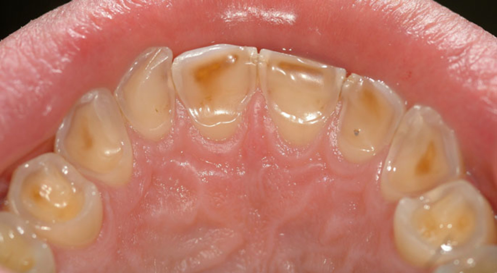 Фото: с металлокерамическими зубами происходит быстрое стирание зубов-антагонистов
