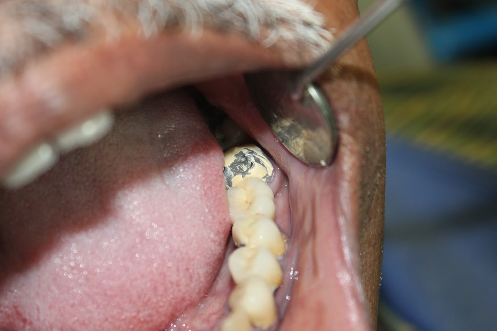 Фото: скол покрытия на металлокерамическом зубе — довольно частая проблема