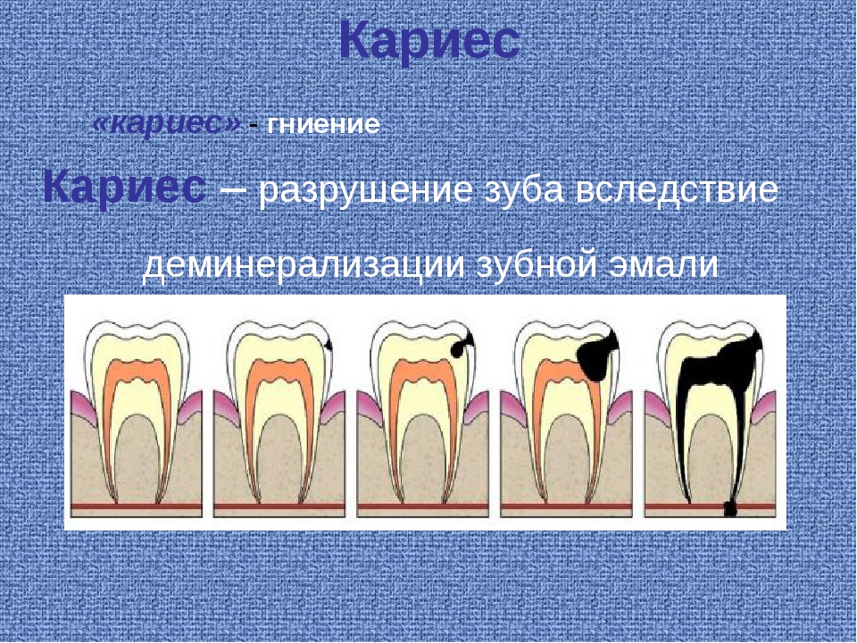 Пульпит и кариес отличия. Кариес зубов деминерализация. Зуб деминерализация эмали кариес. Кариозное разрушение зубов.