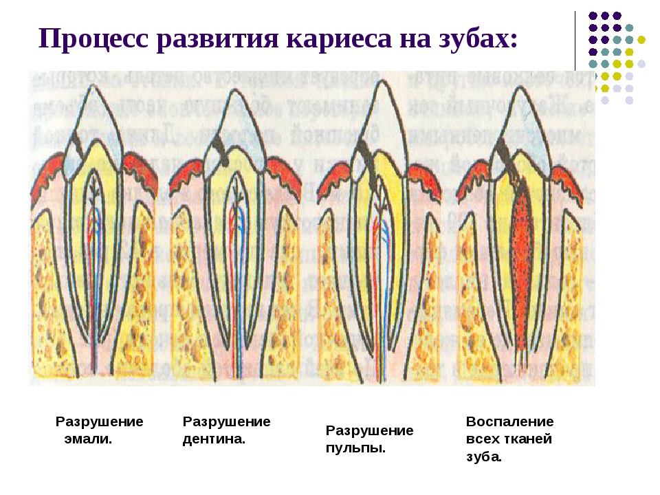 Кариес причины. Кариес эмали кариес дентина.