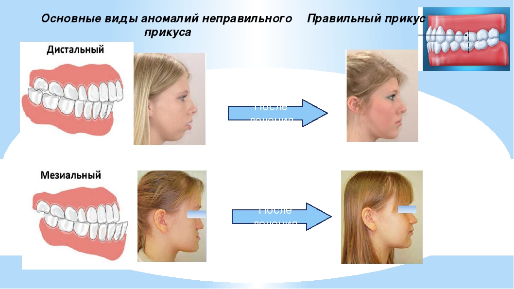 Правильный прикус у человека схема как определить