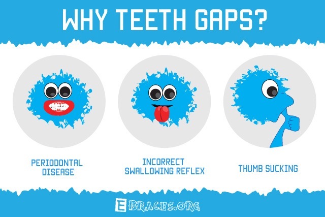 gap in teeth