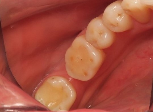 Pathological abrasion of teeth