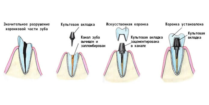 Наращивание зуба на штифт рисунок