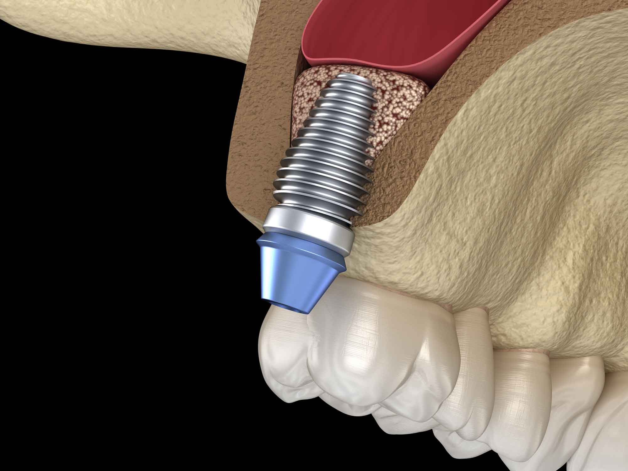 Синусы зуба. Синус-лифтинг гайморова пазуха. Имплант Dentium Superline. Субантральная имплантация.