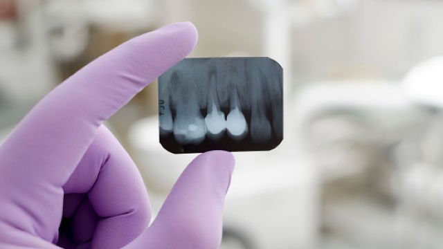 Рентген зуба 