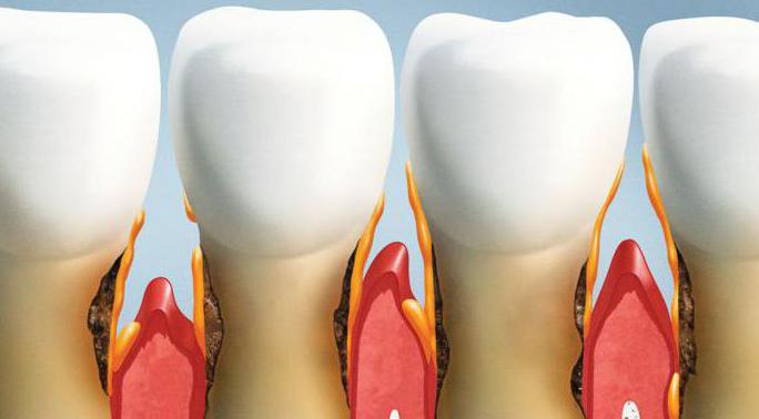 зубные болезни пародонтоз