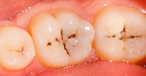 зубные болезни кариес